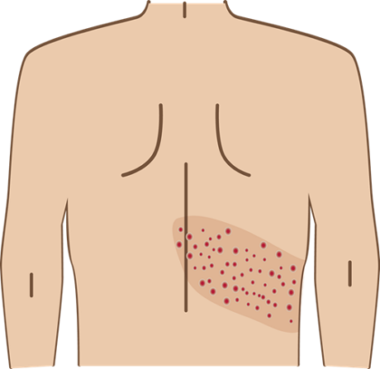 皮膚にピリピリと痛みが生じる
帯状疱疹
